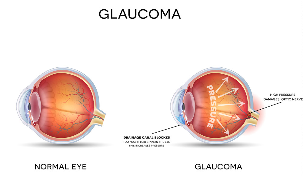 glaucoma-surgery